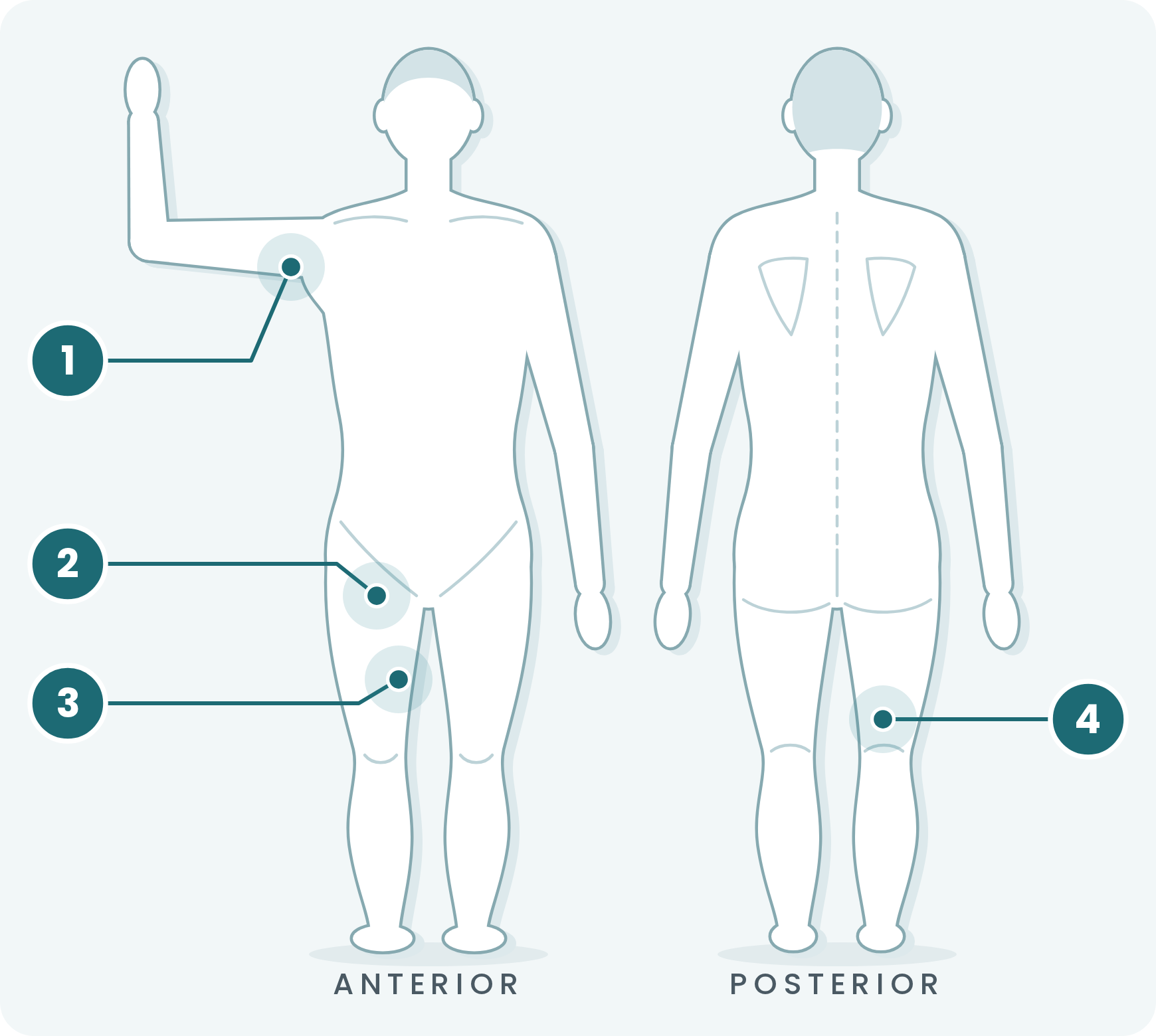 Adult figure, front and back, marking the blocks taught: 1 axillary, 2 femoral, 3 adductor canal, 4 popliteal.
